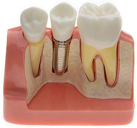 WINECO Diş Öğretim Modeli-Diş Diş Çalışma Ekran Modeli-Reçine Diş İmplant Analizi Kron Köprü Bilim Modelleri-Tıbbi Eğitimsel