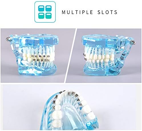 K99 Ortodontik Tedavi Kontrast Ekran Modeli Diş Modeli Parantez ile Diş Maloklüzyon Diş Modeli için Çalışma ve Öğretim